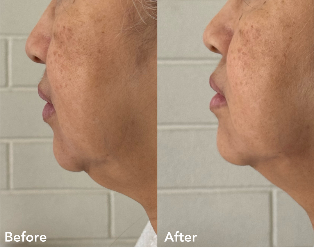 Advanced Dermal Sculpting Mask (10 Masks)